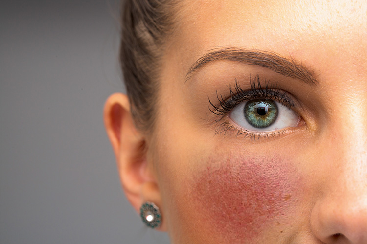 Rosacea / Couperose
